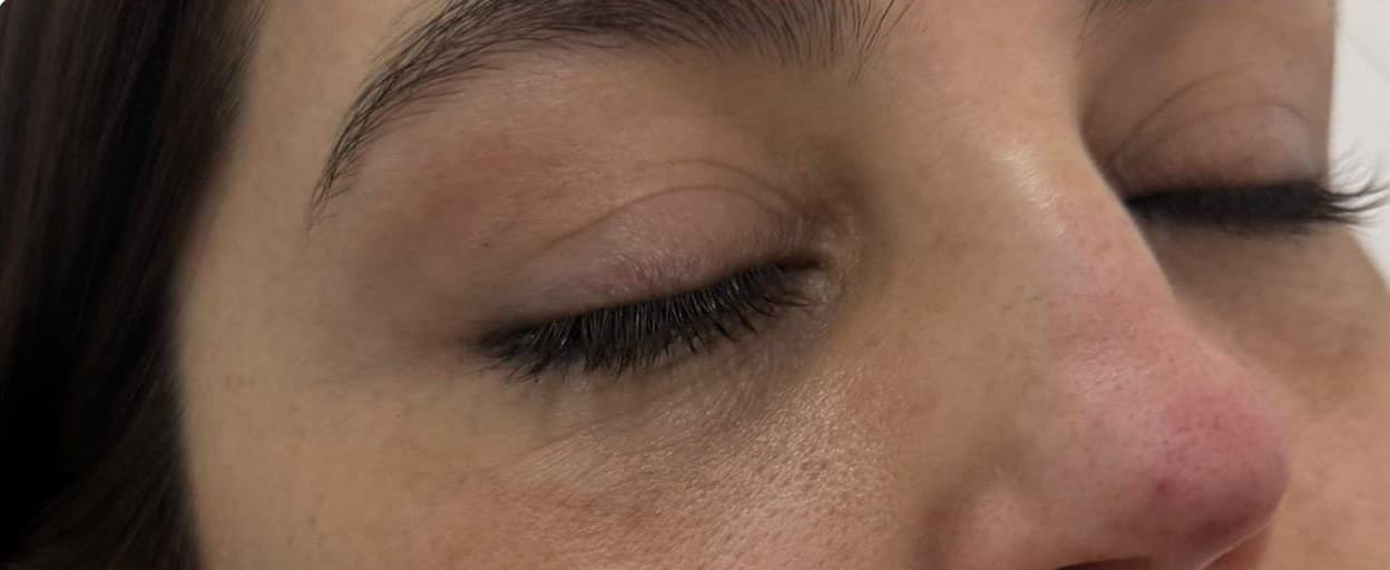 Contorno de ojos antes del tratamiento con exosomas AGF