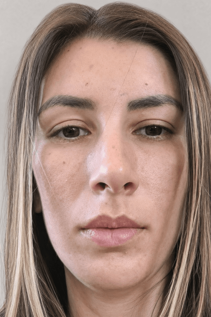 Paciente antes del tratamiento con hilos tensores — óvalo facial y línea mandibular sin definición — A-Estheticnet